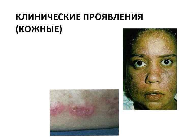 КЛИНИЧЕСКИЕ ПРОЯВЛЕНИЯ (КОЖНЫЕ) 