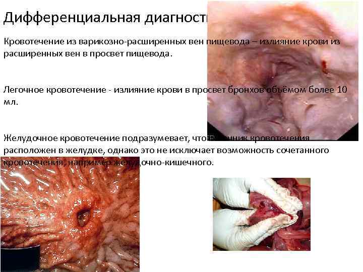 Дифференциальная диагностика кровотечений Кровотечение из варикозно расширенных вен пищевода – излияние крови из расширенных