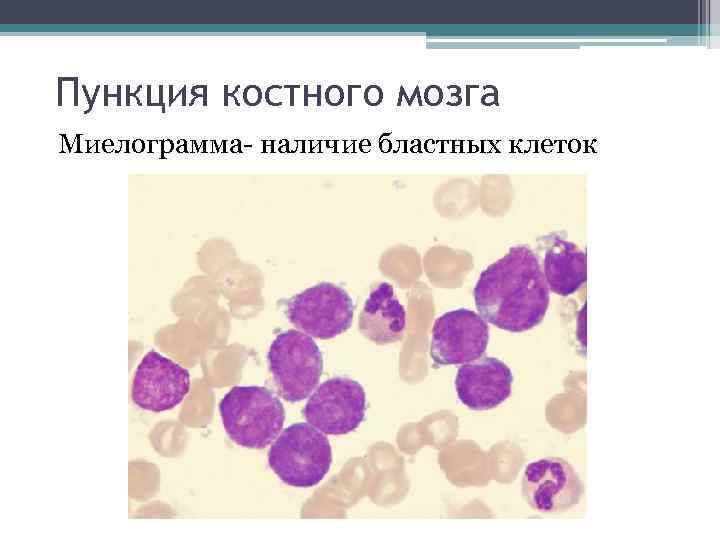 Пункция костного мозга Миелограмма- наличие бластных клеток 