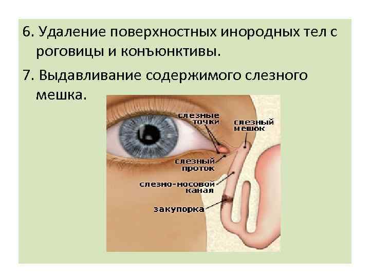 6. Удаление поверхностных инородных тел с роговицы и конъюнктивы. 7. Выдавливание содержимого слезного мешка.