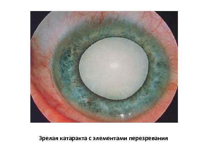 Зрелая катаракта с элементами перезревания 