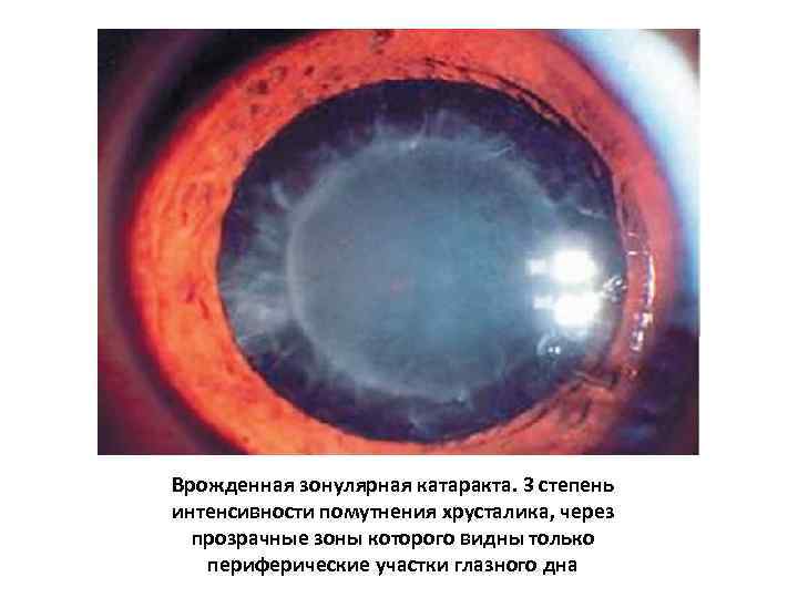 Врожденная зонулярная катаракта. 3 степень интенсивности помутнения хрусталика, через прозрачные зоны которого видны только