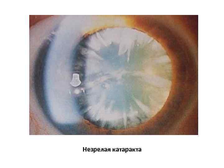Незрелая катаракта 