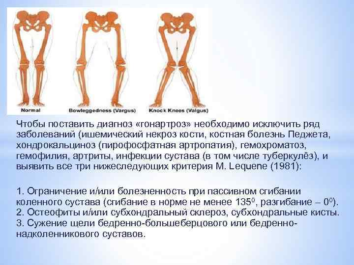 Чтобы поставить диагноз «гонартроз» необходимо исключить ряд заболеваний (ишемический некроз кости, костная болезнь Педжета,