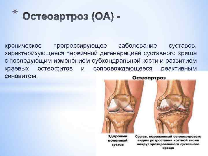 * хроническое прогрессирующее заболевание суставов, характеризующееся первичной дегенерацией суставного хряща с последующим изменением субхондральной