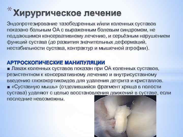 * Эндопротезирование тазобедренных и/или коленных суставов показано больным ОА с выраженным болевым синдромом, не