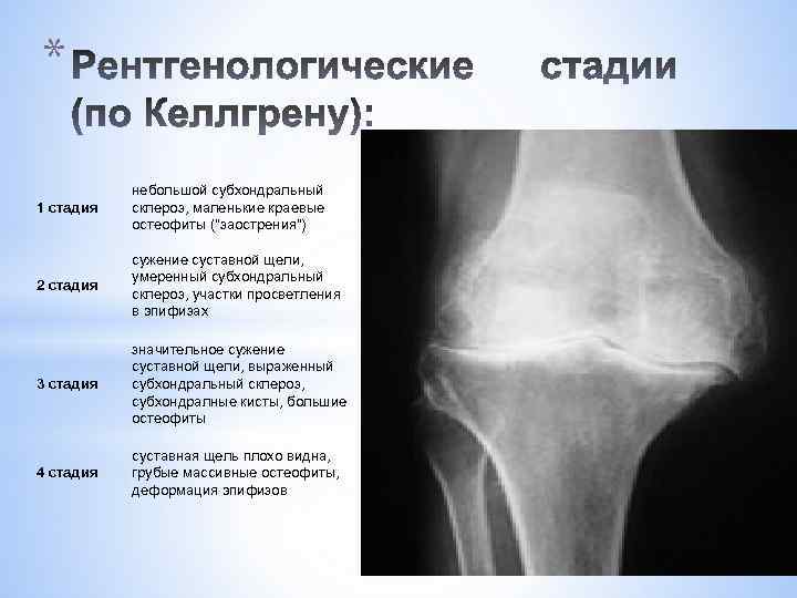 * 1 стадия небольшой субхондральный склероз, маленькие краевые остеофиты (