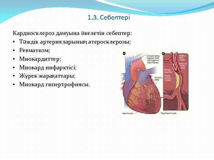 1. 3. Себептері Кардиосклероз дамуына әкелетін себептер: • Тәждік артерияларының атеросклерозы; • Ревматизм; •