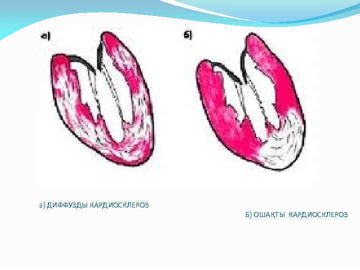 а) ДИФФУЗДЫ КАРДИОСКЛЕРОЗ Б) ОШАҚТЫ КАРДИОСКЛЕРОЗ 