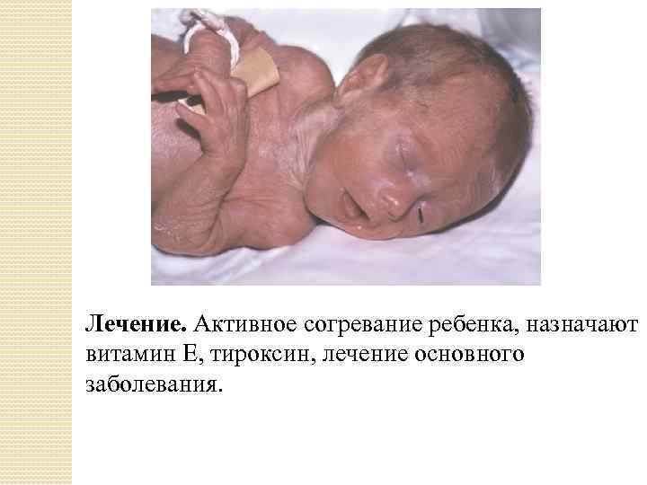 Лечение. Активное согревание ребенка, назначают витамин Е, тироксин, лечение основного заболевания. 