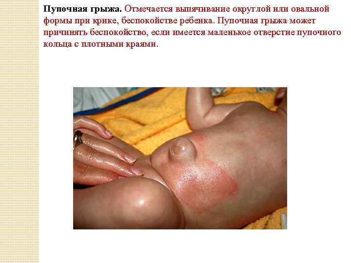 Пупочная грыжа. Отмечается выпячивание округлой или овальной формы при крике, беспокойстве ребенка. Пупочная грыжа