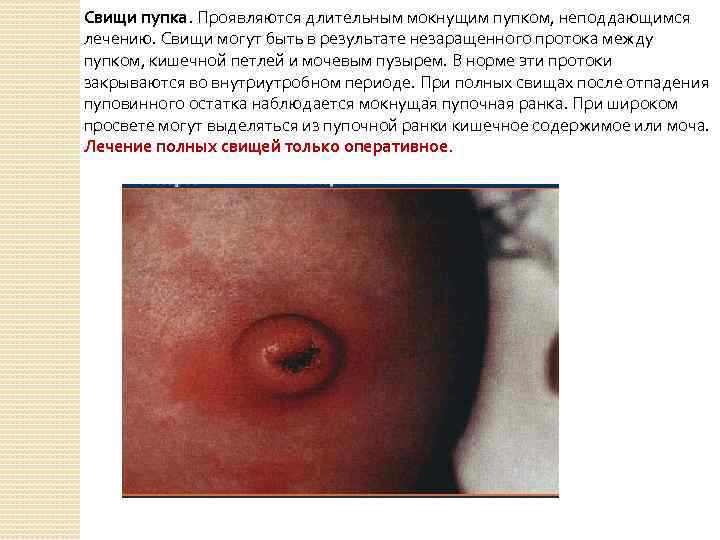 Свищи пупка. Проявляются длительным мокнущим пупком, неподдающимся лечению. Свищи могут быть в результате незаращенного