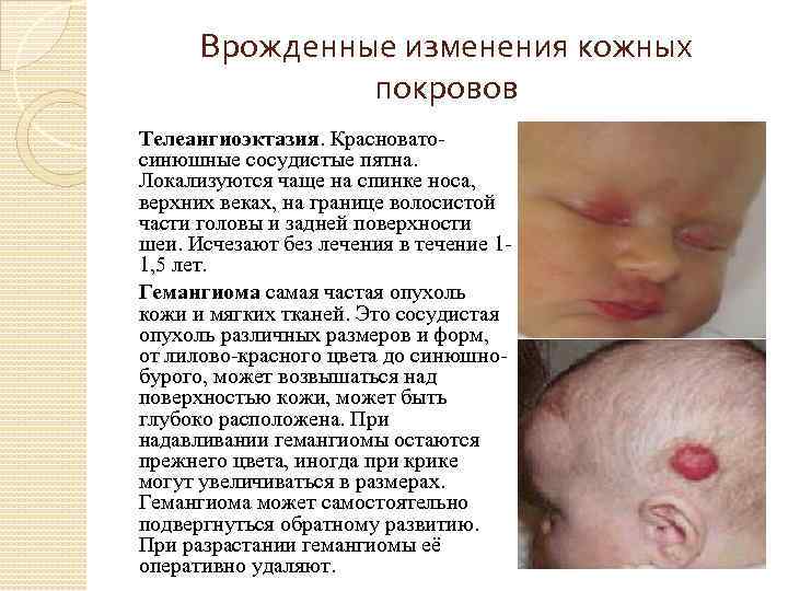 Врожденные изменения кожных покровов Телеангиоэктазия. Красновато- синюшные сосудистые пятна. Локализуются чаще на спинке носа,