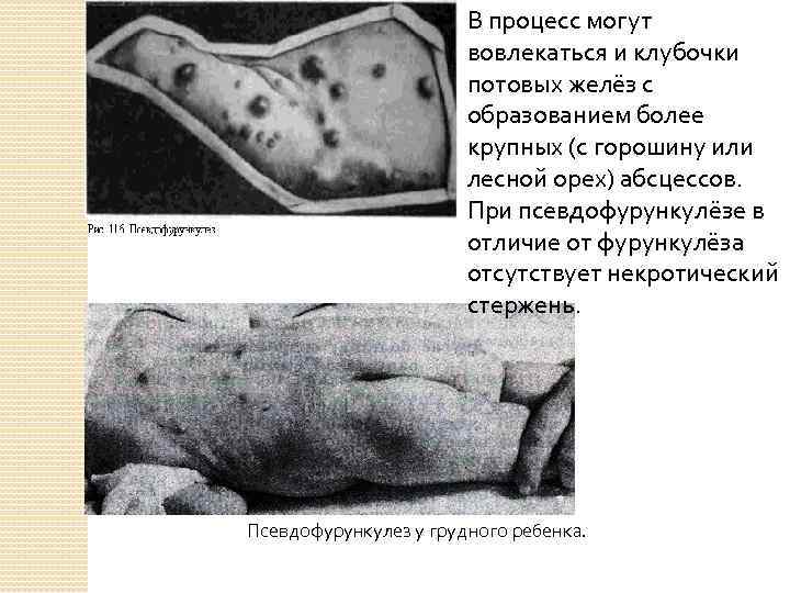 В процесс могут вовлекаться и клубочки потовых желёз с образованием более крупных (с горошину
