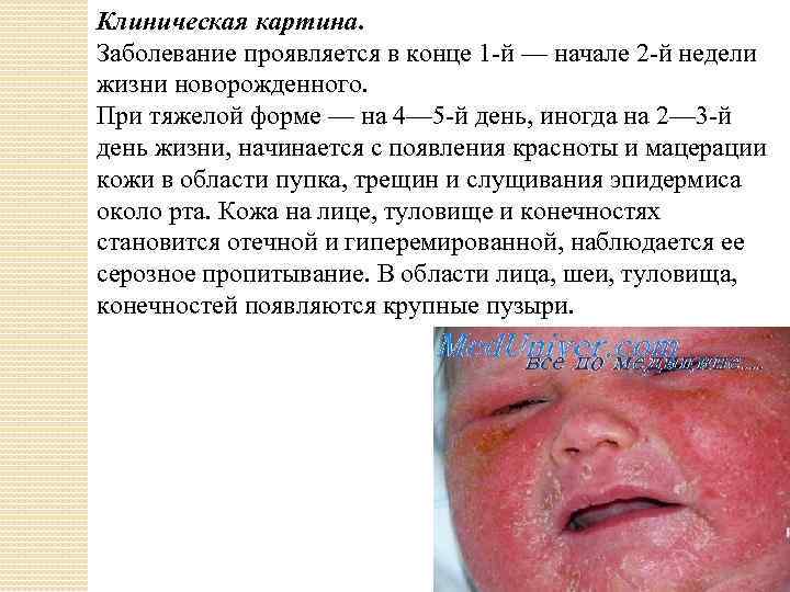 Клиническая картина. Заболевание проявляется в конце 1 -й — начале 2 -й недели жизни
