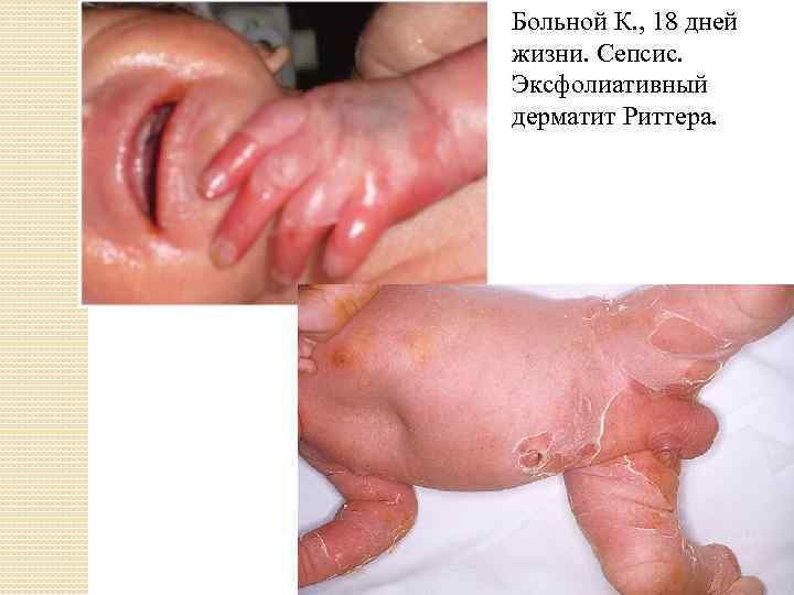 Больной К. , 18 дней жизни. Сепсис. Эксфолиативный дерматит Риттера. 
