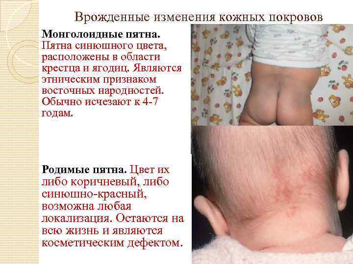 Врожденные изменения кожных покровов Монголоидные пятна. Пятна синюшного цвета, расположены в области крестца и