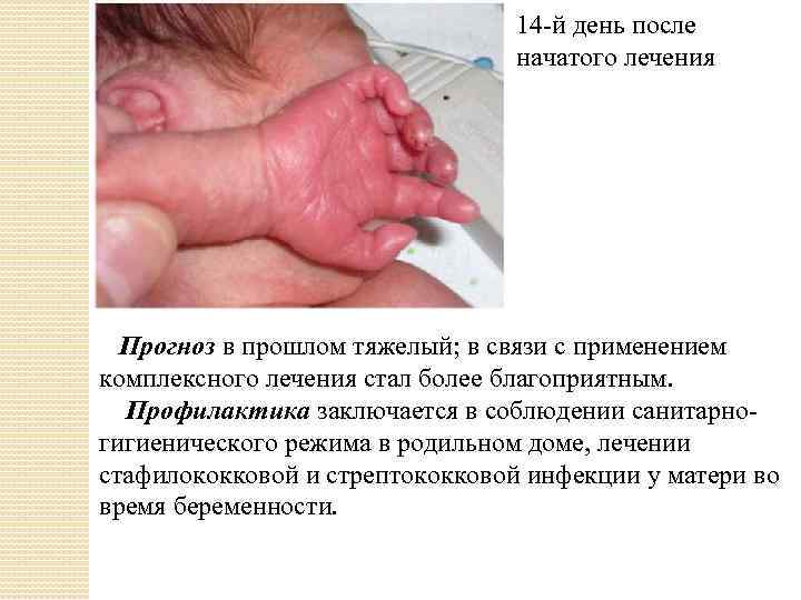 14 -й день после начатого лечения Прогноз в прошлом тяжелый; в связи с применением
