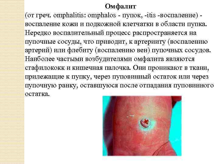Омфалит (от греч. omphalitis: omphalos - пупок, -itis -воспаление) - воспаление кожи и подкожной