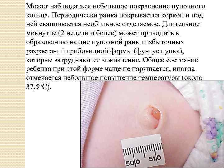 Может наблюдаться небольшое покраснение пупочного кольца. Периодически ранка покрывается коркой и под ней скапливается
