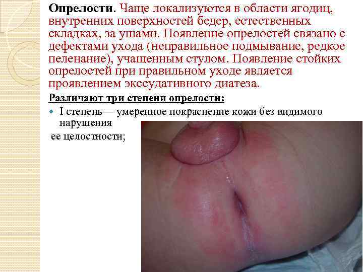 Опрелости. Чаще локализуются в области ягодиц, внутренних поверхностей бедер, естественных складках, за ушами. Появление