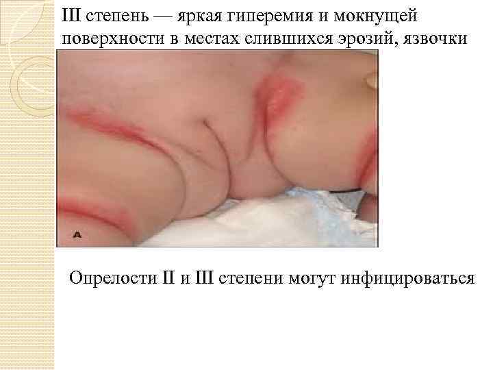III степень — яркая гиперемия и мокнущей поверхности в местах слившихся эрозий, язвочки Опрелости