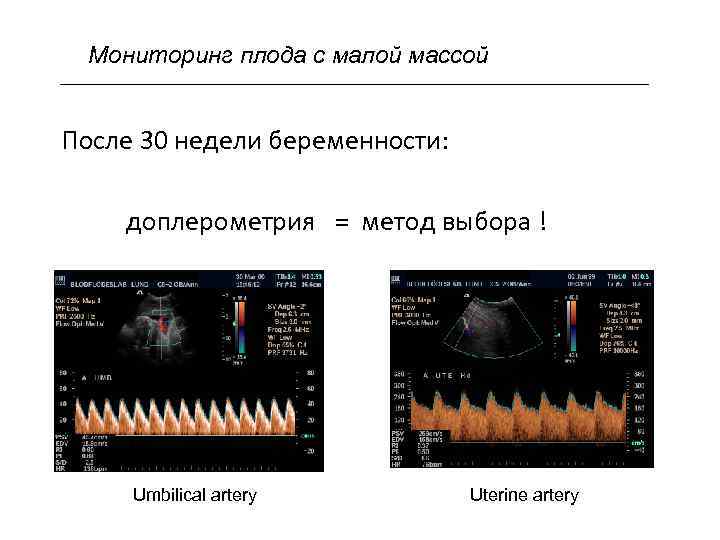 Мониторинг плода с малой массой После 30 недели беременности: доплерометрия = метод выбора !