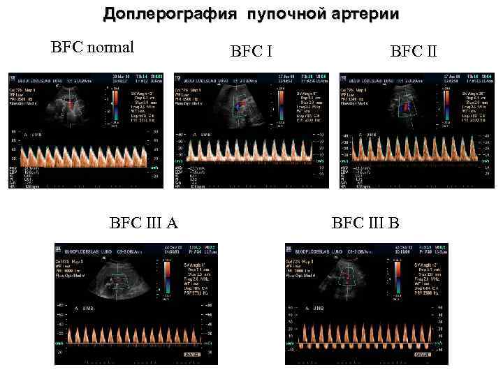 Доплерография пупочной артерии BFC normal BFC III A BFC III B 