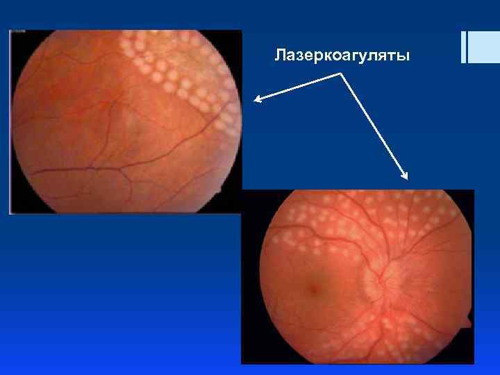 Лазеркоагуляты 