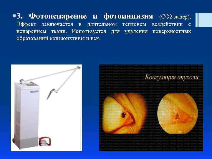 § 3. Фотоиспарение и фотоинцизия (СО 2 -лазер). Эффект заключается в длительном тепловом воздействии
