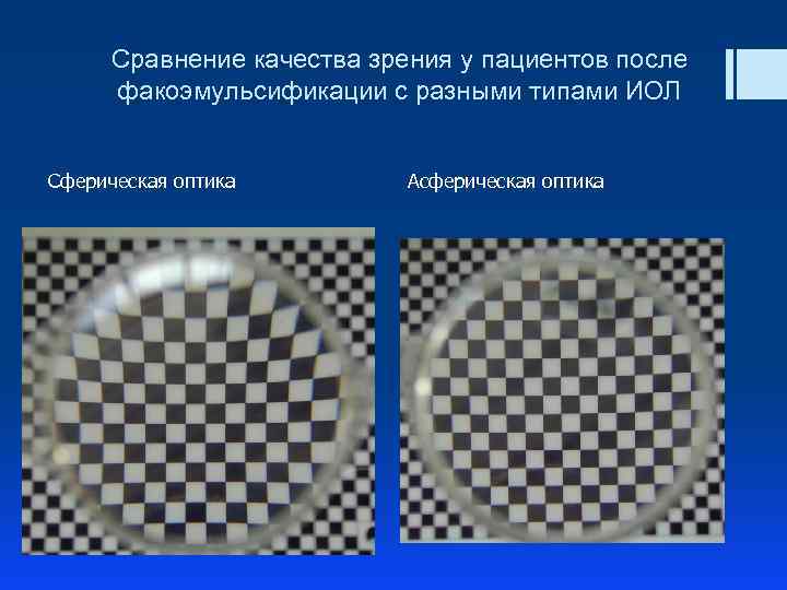Сравнение качества зрения у пациентов после факоэмульсификации с разными типами ИОЛ Сферическая оптика Асферическая