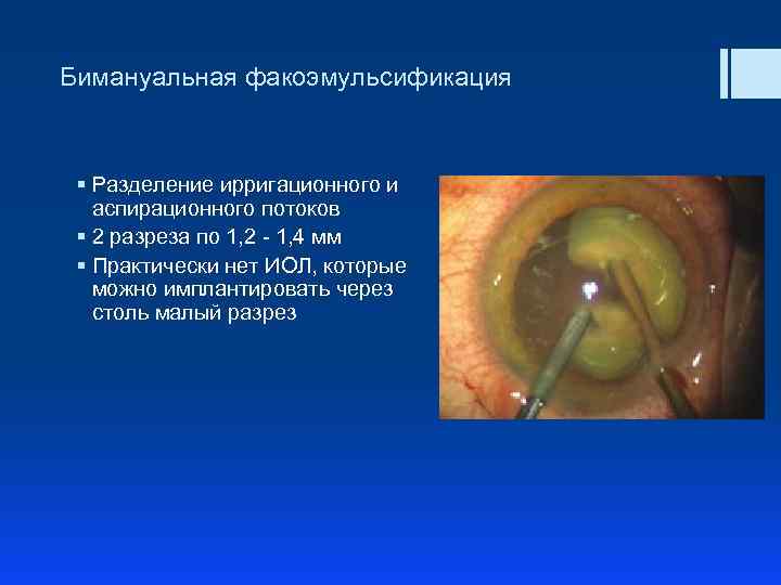 Бимануальная факоэмульсификация § Разделение ирригационного и аспирационного потоков § 2 разреза по 1, 2