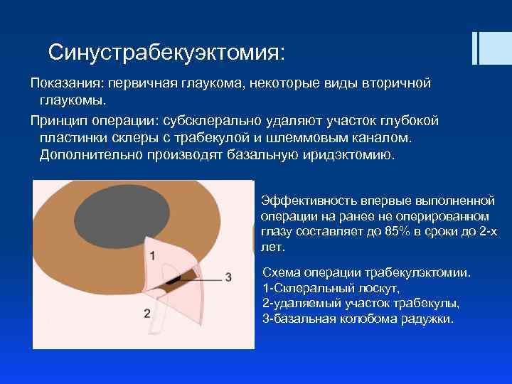 Синустрабекуэктомия: Показания: первичная глаукома, некоторые виды вторичной глаукомы. Принцип операции: субсклерально удаляют участок глубокой