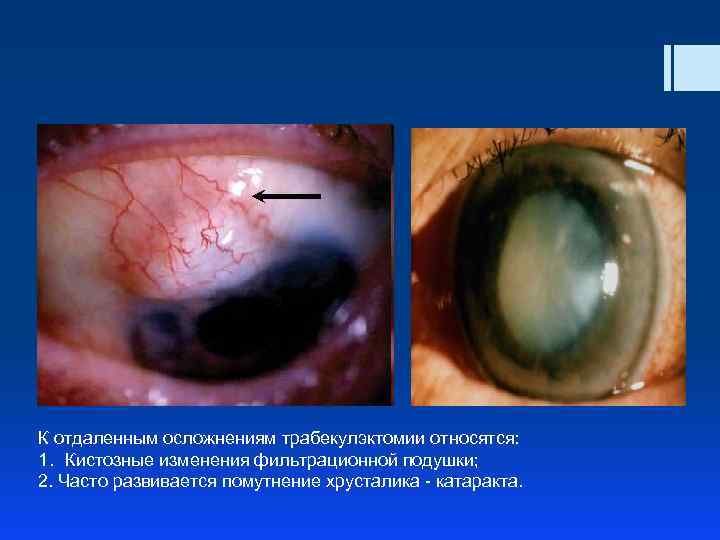К отдаленным осложнениям трабекулэктомии относятся: 1. Кистозные изменения фильтрационной подушки; 2. Часто развивается помутнение