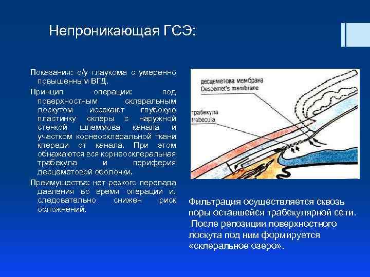 Непроникающая ГСЭ: Показания: о/у глаукома с умеренно повышенным ВГД. Принцип операции: под поверхностным склеральным