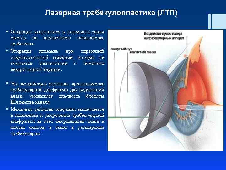 Лазерная трабекулопластика (ЛТП) § Операция заключается в нанесении серии ожогов на внутреннюю поверхность трабекулы.