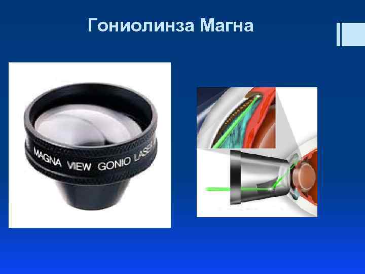 Гониолинза Магна 