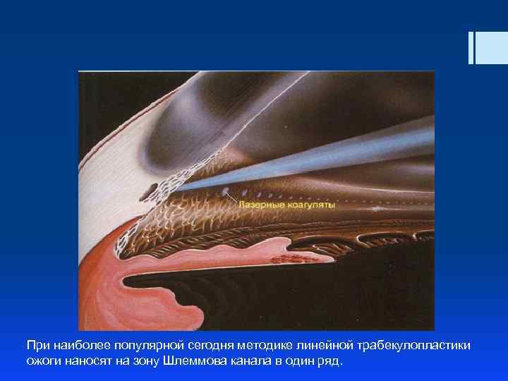 При наиболее популярной сегодня методике линейной трабекулопластики ожоги наносят на зону Шлеммова канала в