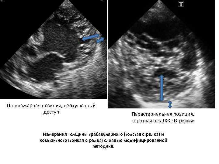 Пятикамерная позиция, верхушечный доступ Парастернальная позиция, короткая ось ЛЖ ; В-режим Измерения толщины трабекулярного