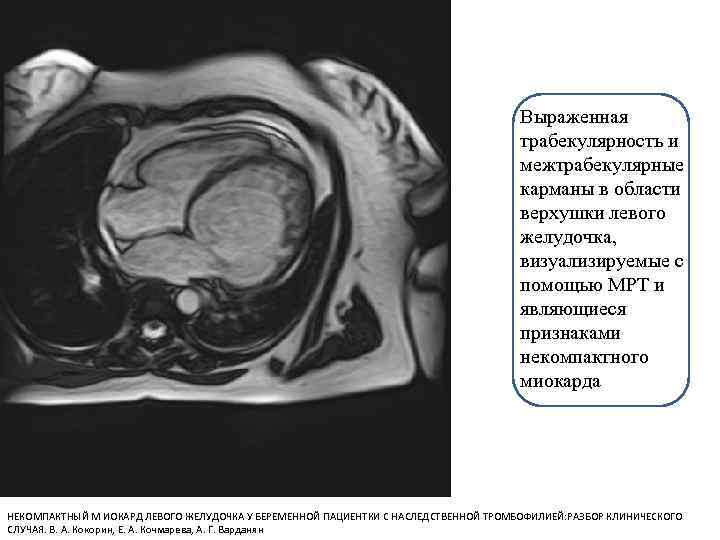 Выраженная трабекулярность и межтрабекулярные карманы в области верхушки левого желудочка, визуализируемые с помощью МРТ