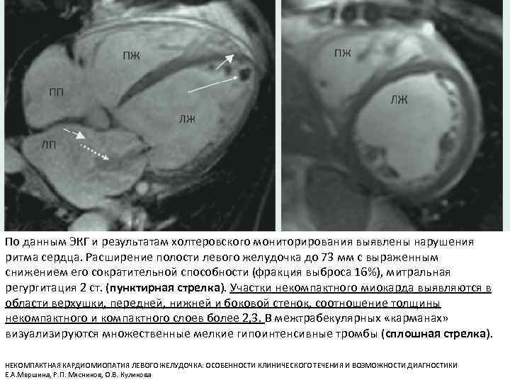 По данным ЭКГ и результатам холтеровского мониторирования выявлены нарушения ритма сердца. Расширение полости левого