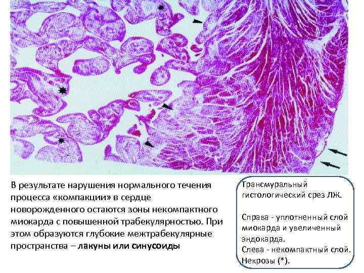 В результате нарушения нормального течения процесса «компакции» в сердце новорожденного остаются зоны некомпактного миокарда