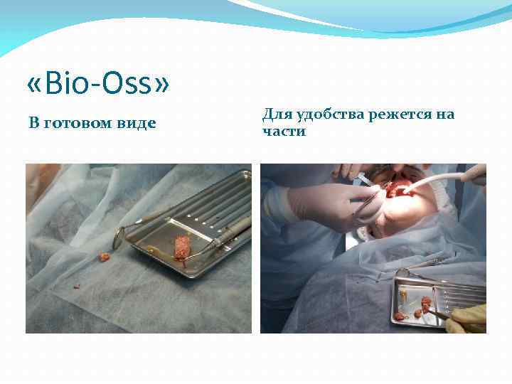  «Bio-Oss» В готовом виде Для удобства режется на части 