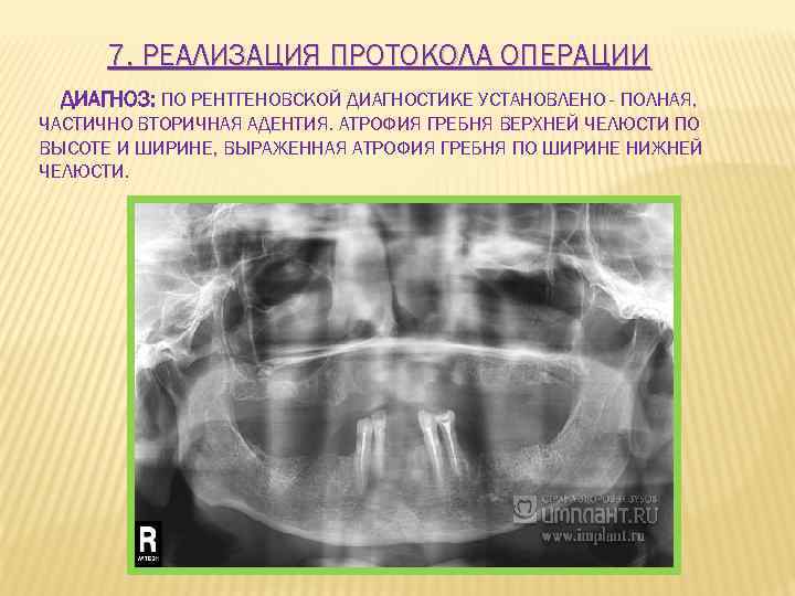 7. РЕАЛИЗАЦИЯ ПРОТОКОЛА ОПЕРАЦИИ ДИАГНОЗ: ПО РЕНТГЕНОВСКОЙ ДИАГНОСТИКЕ УСТАНОВЛЕНО - ПОЛНАЯ, ЧАСТИЧНО ВТОРИЧНАЯ АДЕНТИЯ.