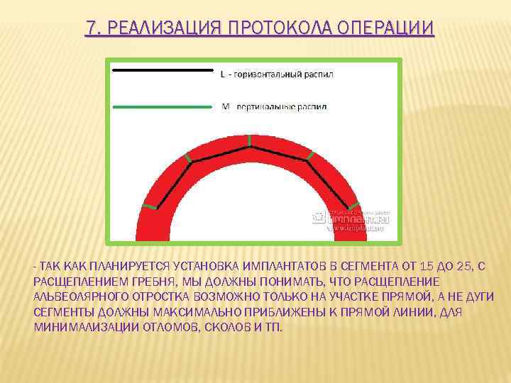 7. РЕАЛИЗАЦИЯ ПРОТОКОЛА ОПЕРАЦИИ - ТАК КАК ПЛАНИРУЕТСЯ УСТАНОВКА ИМПЛАНТАТОВ В СЕГМЕНТА ОТ 15