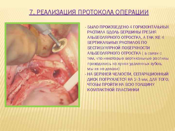 7. РЕАЛИЗАЦИЯ ПРОТОКОЛА ОПЕРАЦИИ - БЫЛО ПРОИЗВЕДЕНО 4 ГОРИЗОНТАЛЬНЫХ РАСПИЛА ВДОЛЬ ВЕРШИНЫ ГРЕБНЯ АЛЬВЕОЛЯРНОГО