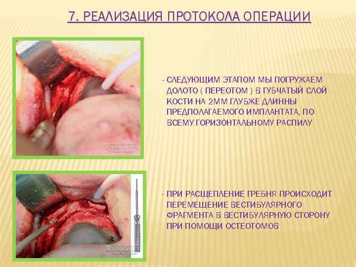 7. РЕАЛИЗАЦИЯ ПРОТОКОЛА ОПЕРАЦИИ - СЛЕДУЮЩИМ ЭТАПОМ МЫ ПОГРУЖАЕМ ДОЛОТО ( ПЕРЕОТОМ ) В