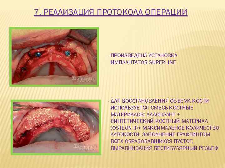 7. РЕАЛИЗАЦИЯ ПРОТОКОЛА ОПЕРАЦИИ - ПРОИЗВЕДЕНА УСТАНОВКА ИМПЛАНТАТОВ SUPERLINE - ДЛЯ ВОССТАНОВЛЕНИЯ ОБЪЕМА КОСТИ