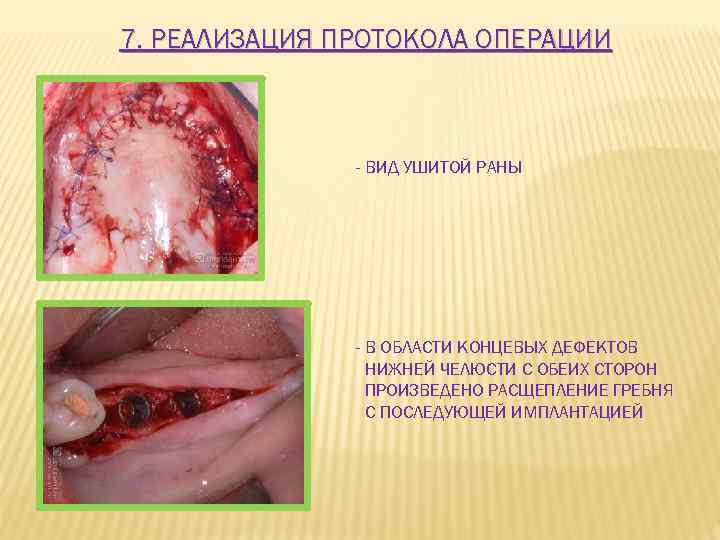 7. РЕАЛИЗАЦИЯ ПРОТОКОЛА ОПЕРАЦИИ - ВИД УШИТОЙ РАНЫ - В ОБЛАСТИ КОНЦЕВЫХ ДЕФЕКТОВ НИЖНЕЙ