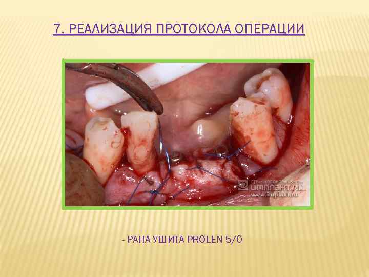 7. РЕАЛИЗАЦИЯ ПРОТОКОЛА ОПЕРАЦИИ - РАНА УШИТА PROLEN 5/0 